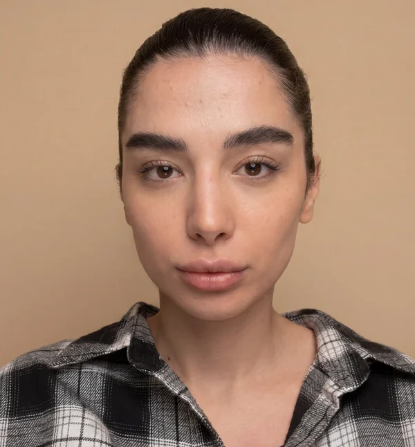 چهره پس از تزریق فیلر، نمونهٔ کلینیک لمون