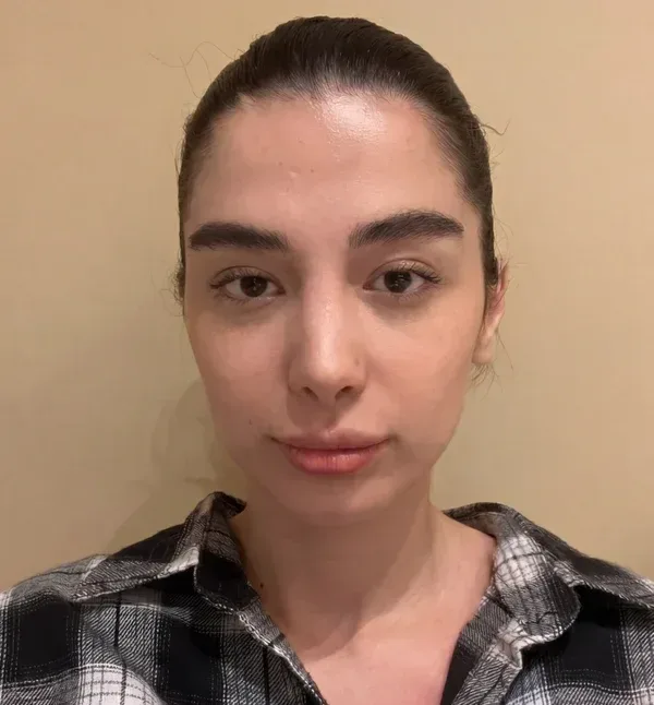 چهره پیش از تزریق فیلر، نمونهٔ کلینیک لمون