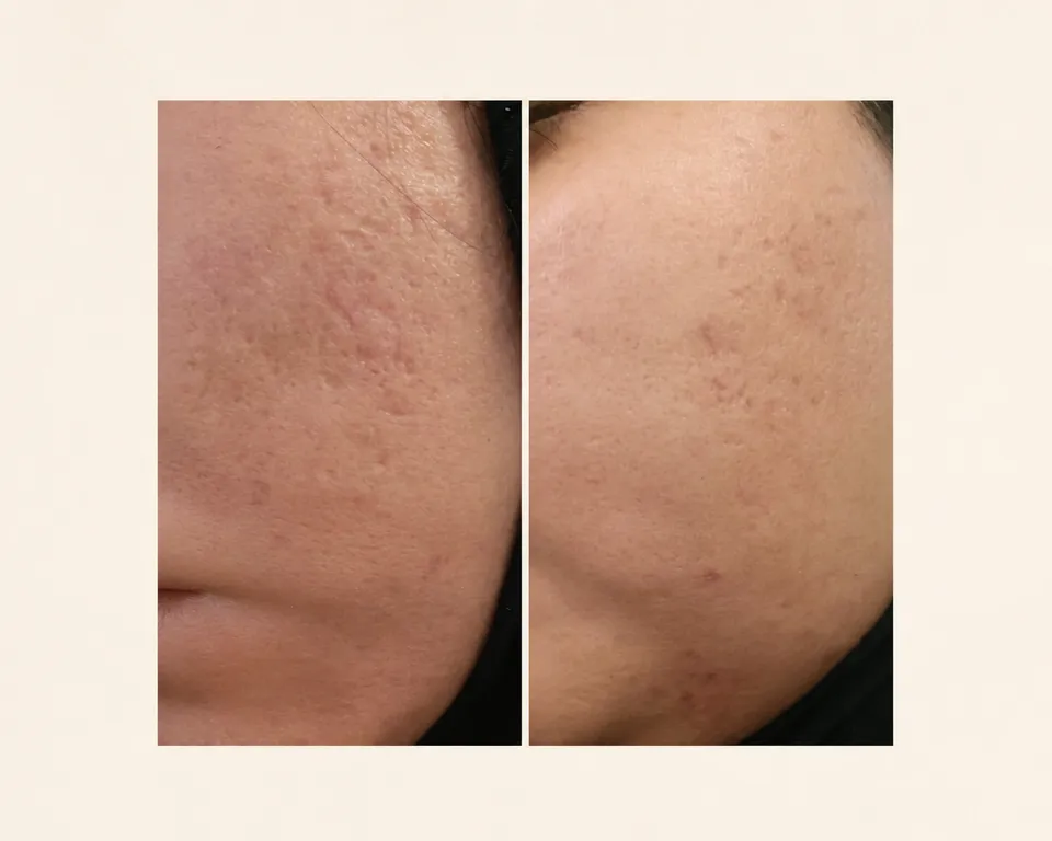 سابسیژن، رفع اسکار، قبل و بعد در کلینیک زیبایی لمون، توسط دکتر غفوری